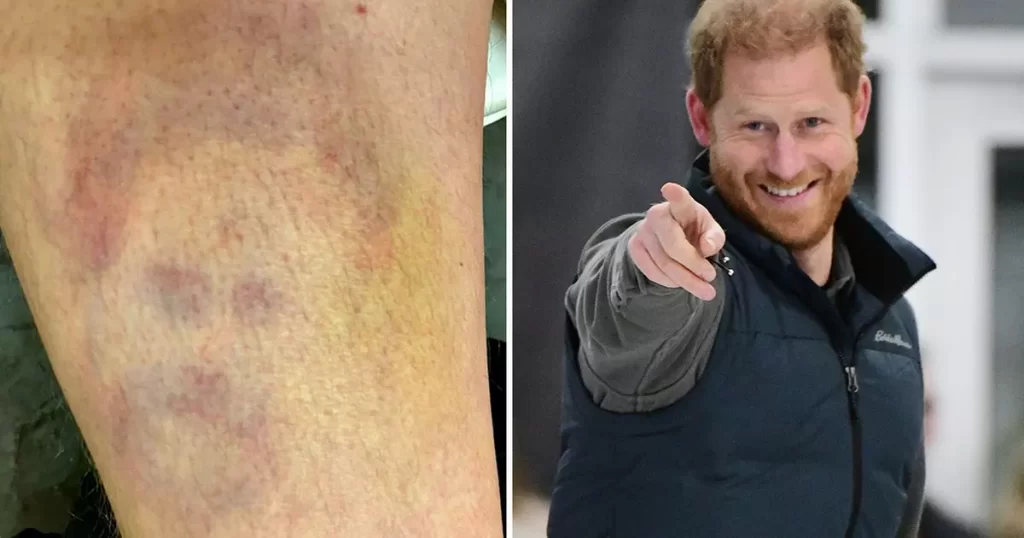 Man Sees Prince Harry with Bruise After Soccer Injury – Friends Call Him ‘The Chosen One’