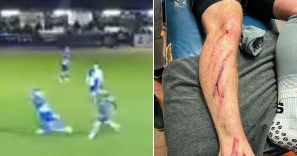 Non-league player expresses anger towards referee following serious injury, fans attribute it to ‘Pringle shin-pad’.